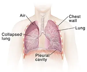 collepsed-lung