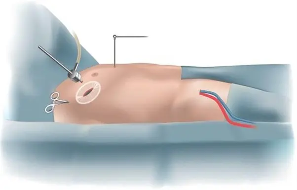 minimally-invasive-heart-surgery