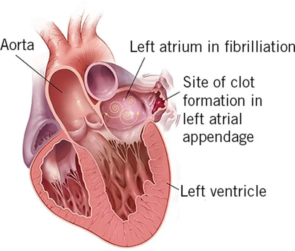 thoracoscopic-occlusion-of-left-atrial-appendage-with-atriclip